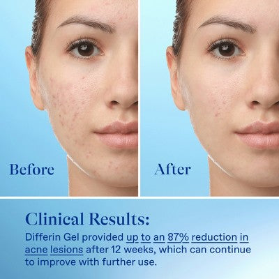 Differin Retinoid Acne Treatment; Adapalene Gel 0.1% 45g/1.6oz - Imperfect Box